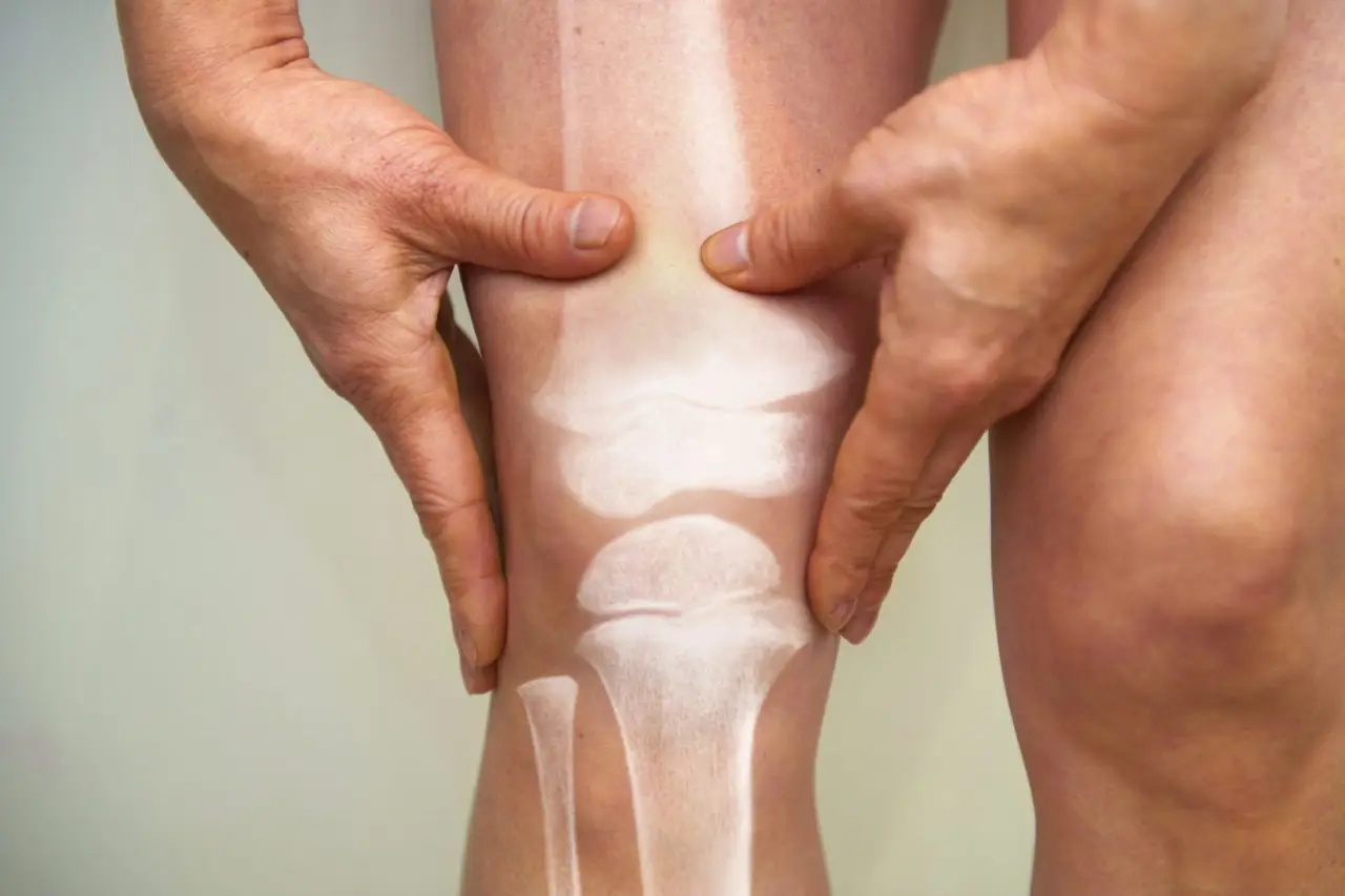 Prevenire l’osteoporosi: quali alimenti scegliere secondo la nutrizionista Prevenire l’osteoporosi: quali alimenti scegliere secondo la nutrizionista